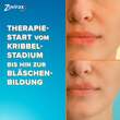 Zovirax Lippenherpes Creme - 6