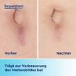 Bepancare Narben-Gel - 3