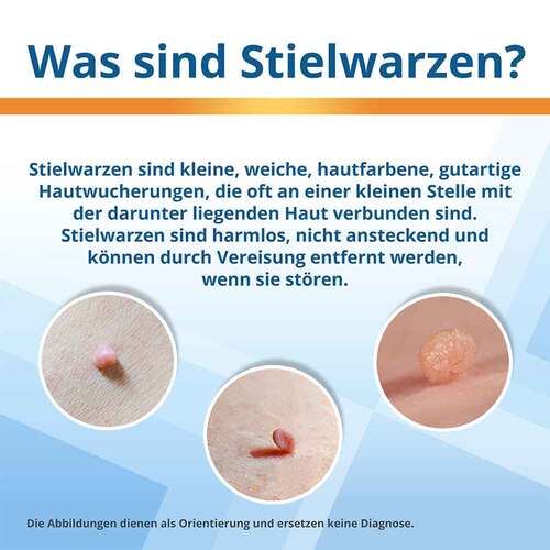 Endwarts Extra gegen Stielwarzen - 4