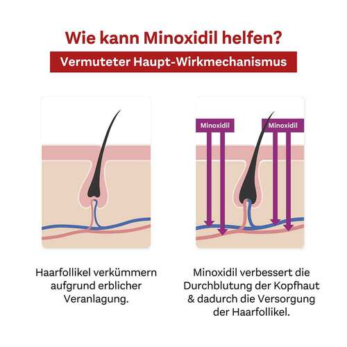 Minoxidil DoppelherzPhar.20mg / ml L&ouml;sung Anw.Haut Frau - 7