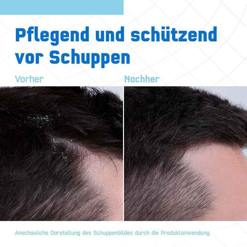 Terzolin Expert Shampoo bei trockener Kopfhaut - 4