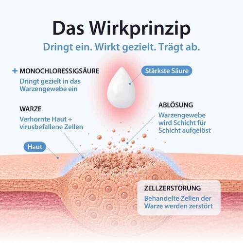 Acetocaustin L&ouml;sung Warzenmittel - 4
