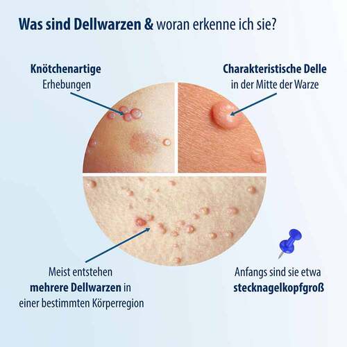 Evolsin Dellwarzen Mittel L&ouml;sung - 2