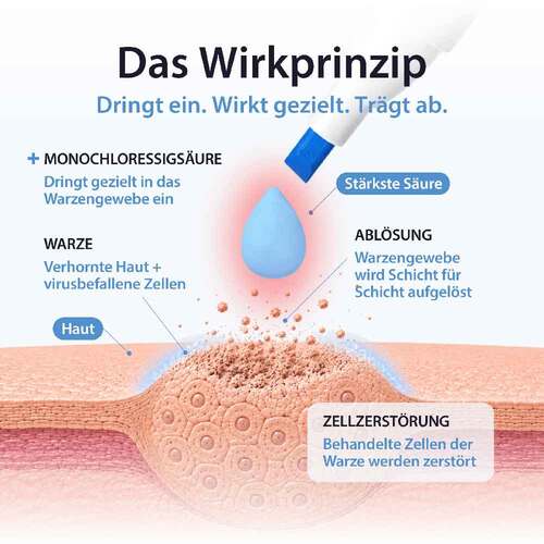 Acetocaustin Stift gegen Warzen - 4